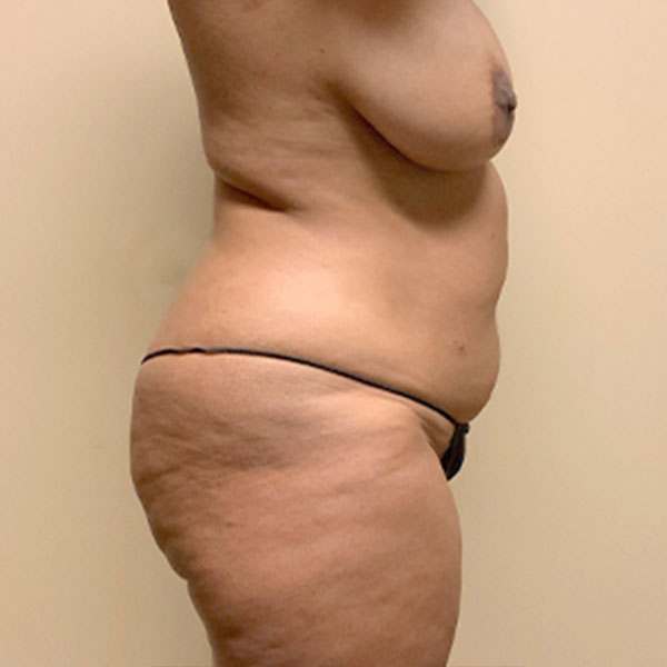 Liposuction Lower Back 07