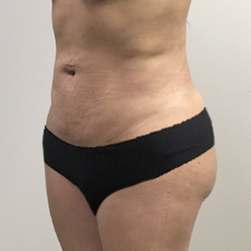 Liposuction Lower Back 05