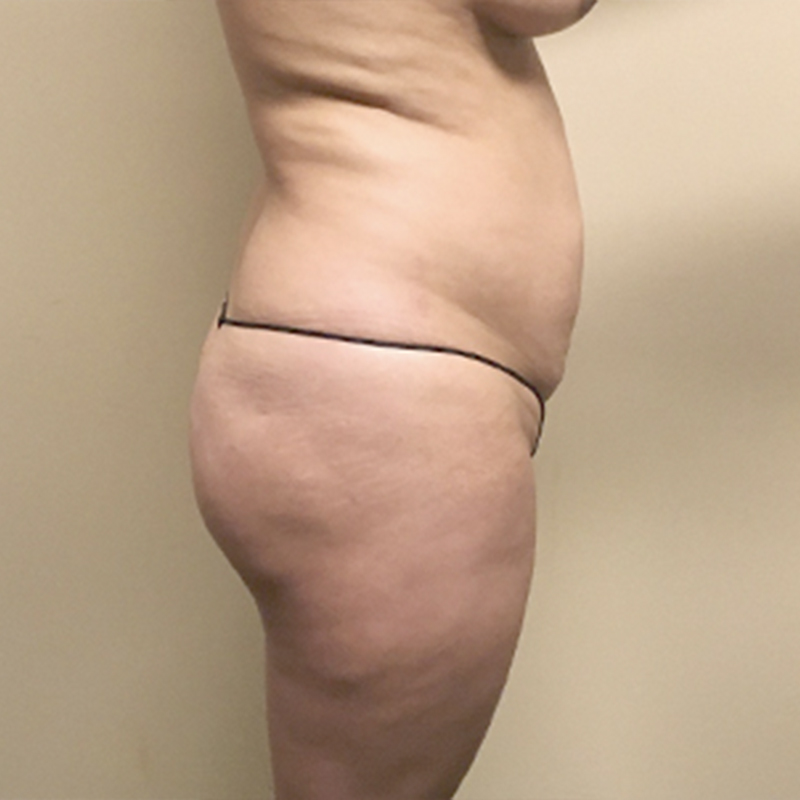 Liposuction Lower Back 07