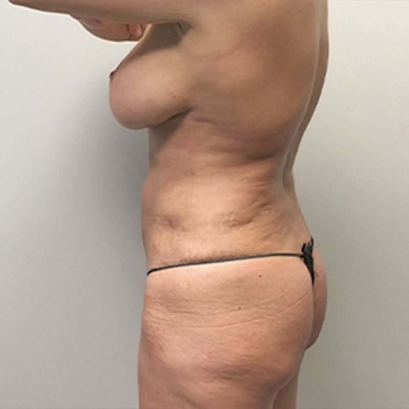 Liposuction Lower Back 09