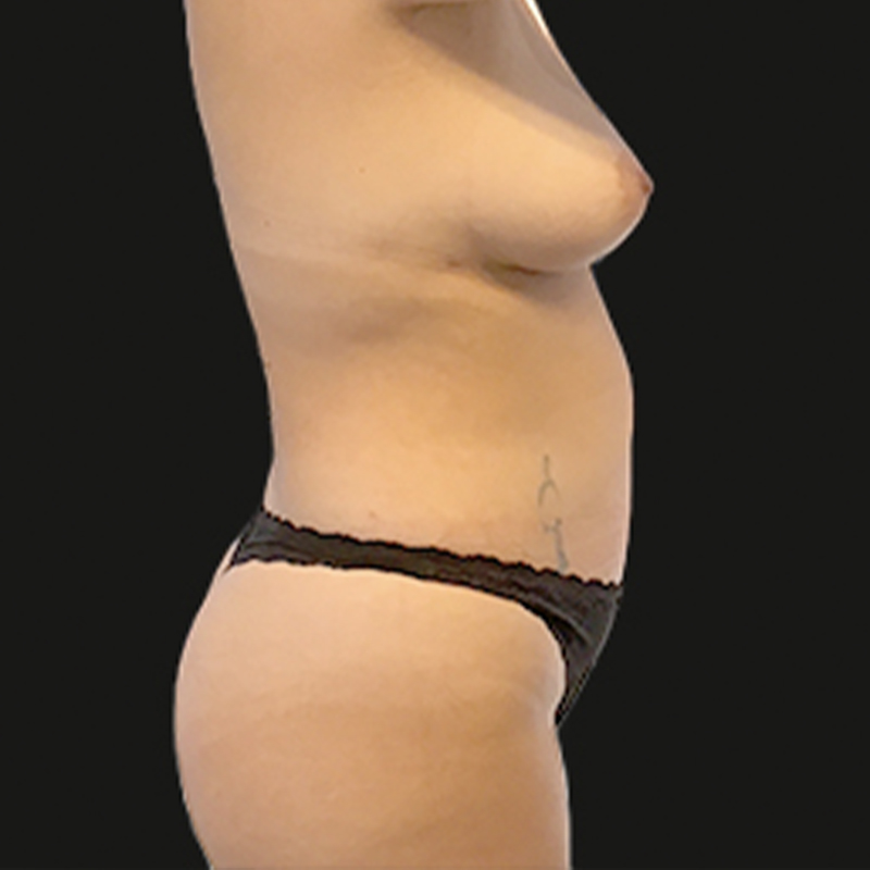 Liposuction Lower Back 05