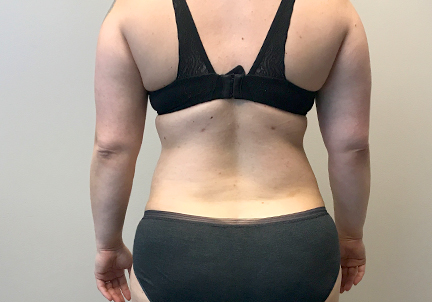 Liposuction Upper Back 01