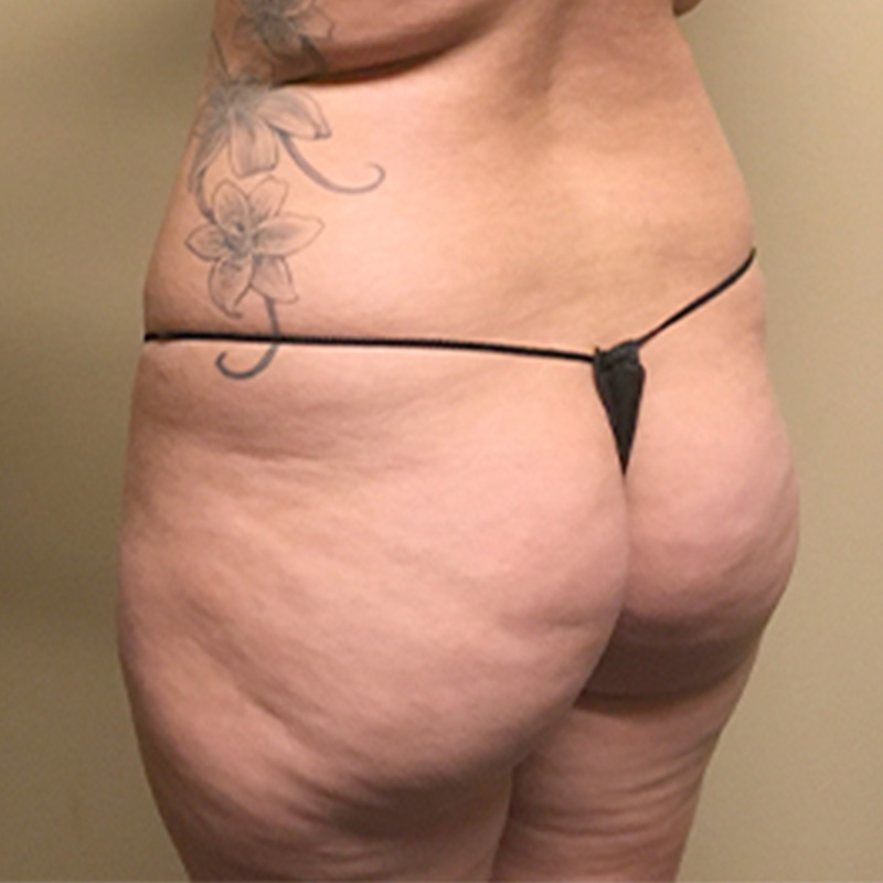 Liposuction Upper Back 03