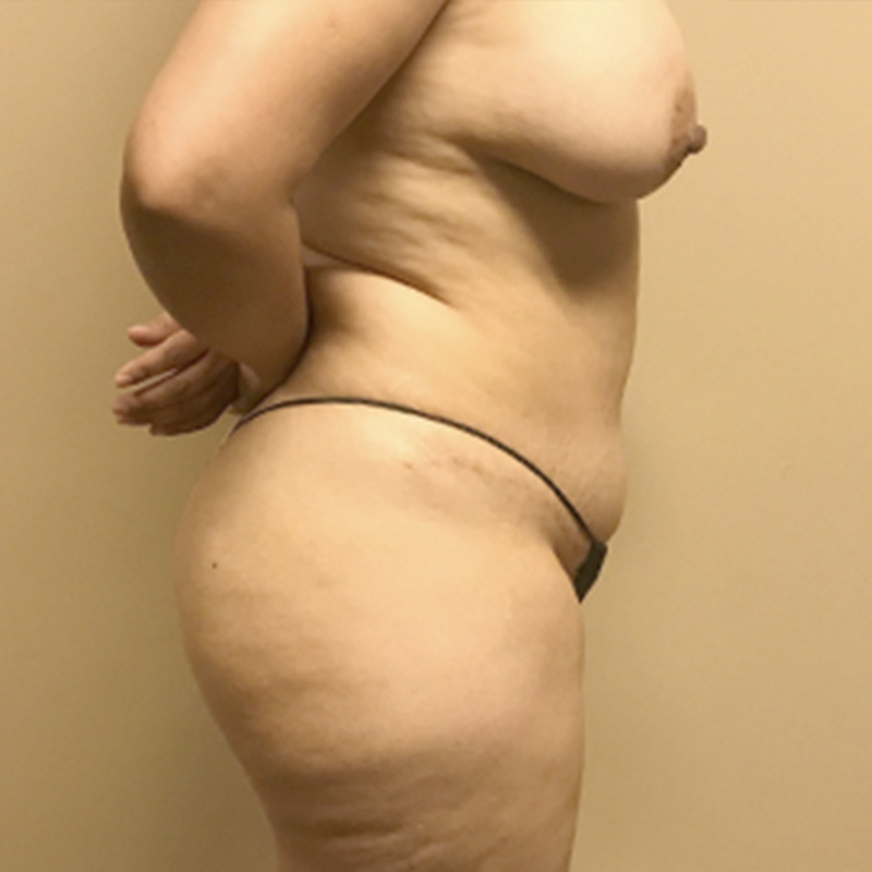 Liposuction Upper Back 05