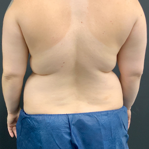 Liposuction Upper Back 01