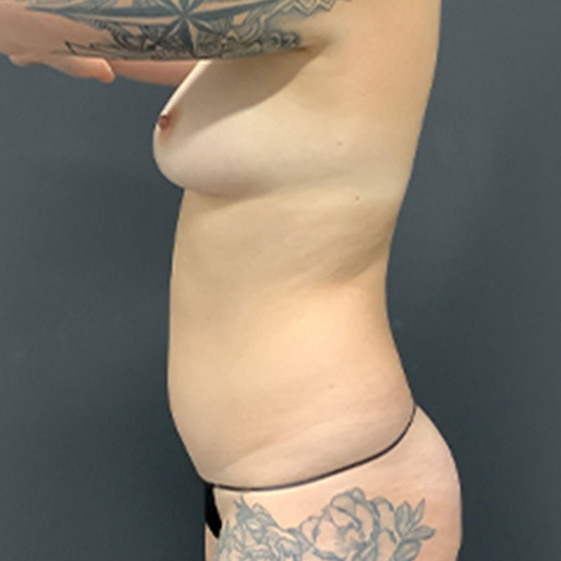 Liposuction Waist 05