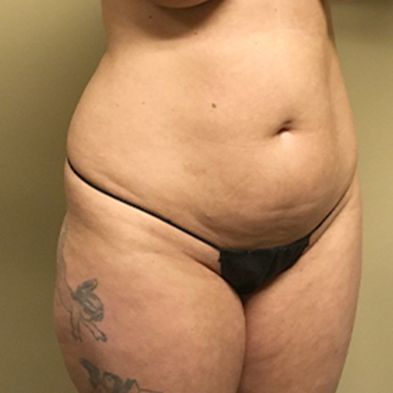 Liposuction Waist 07