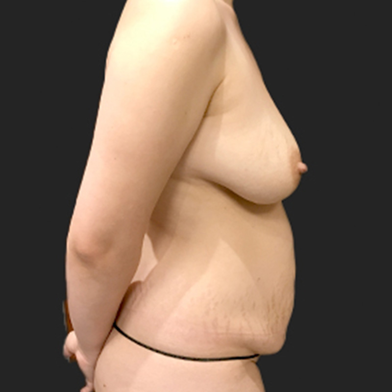 Liposuction Waist 05