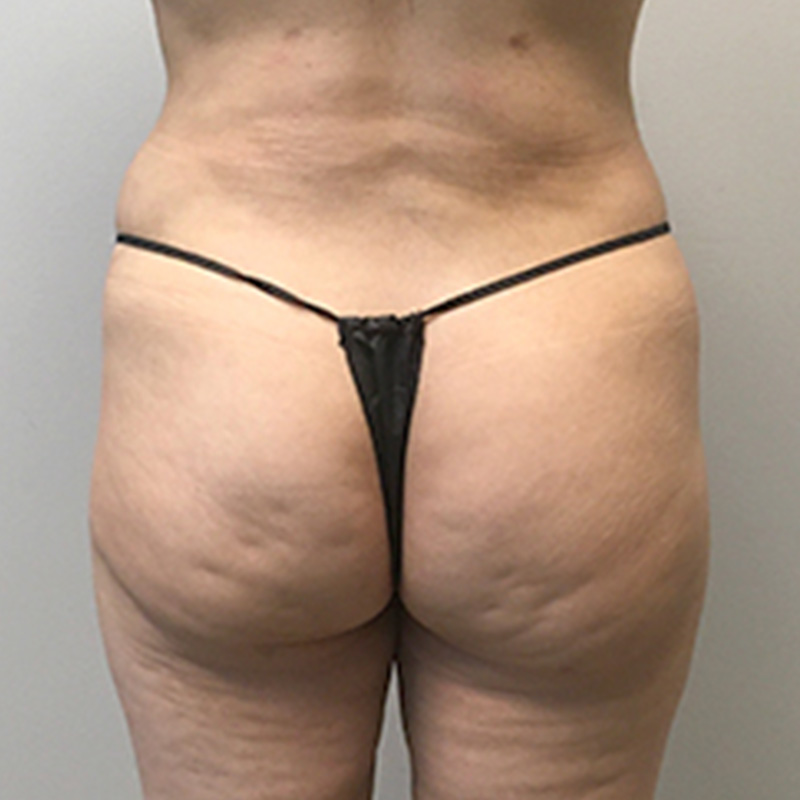 Liposuction Waist 04