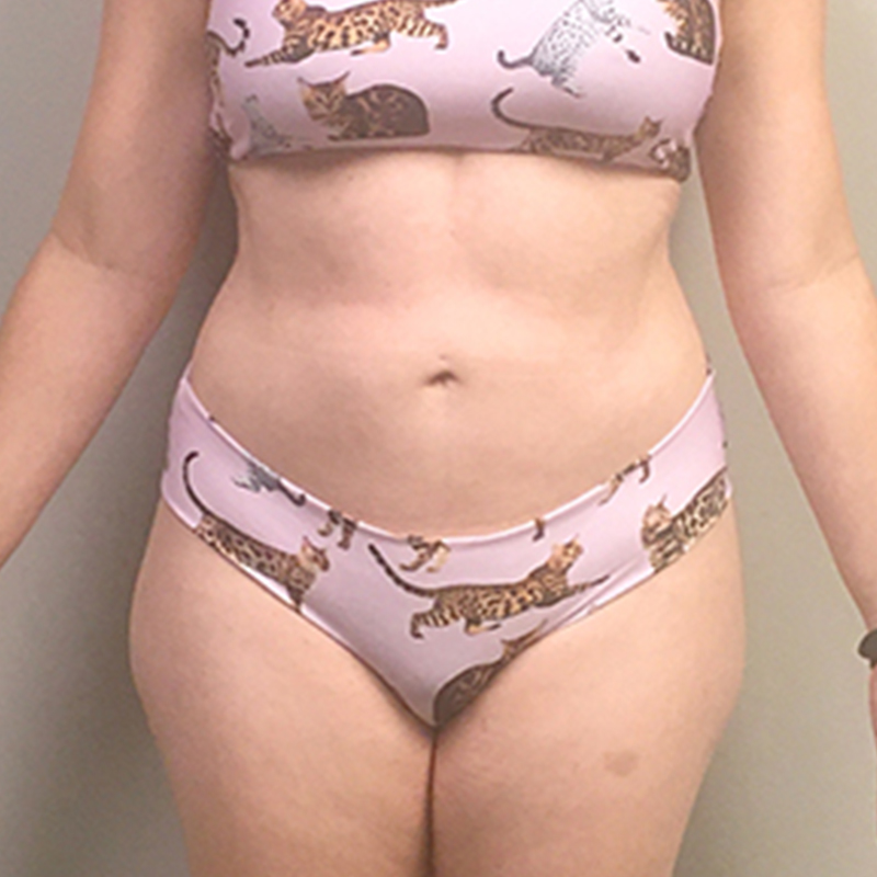 Liposuction Waist 09