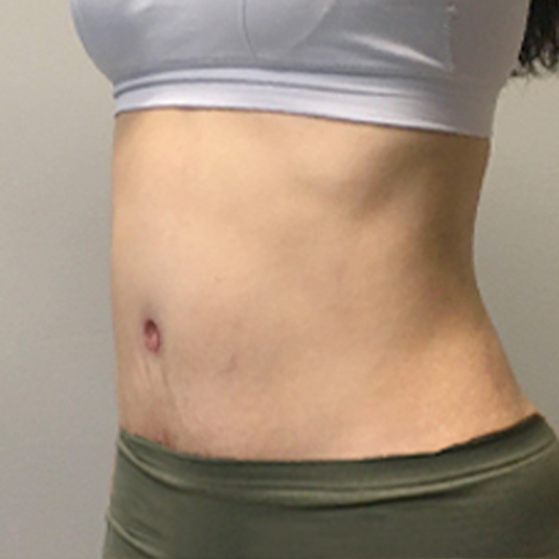 Liposuction Waist 03