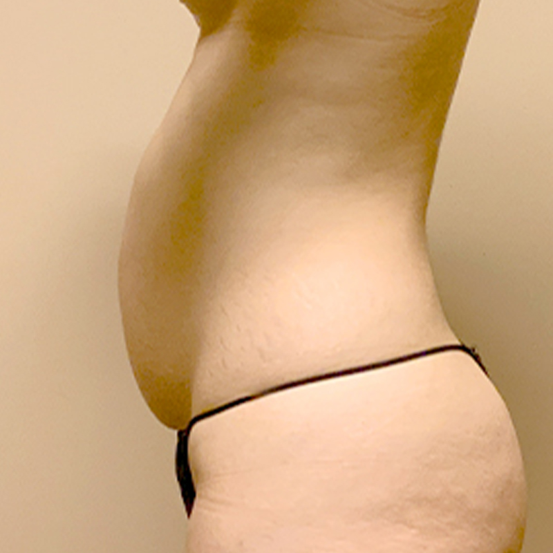 Liposuction Waist 05