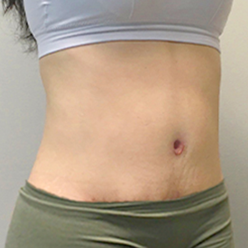 Liposuction Waist 07