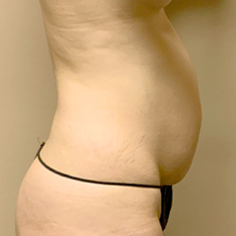 Liposuction Waist 09
