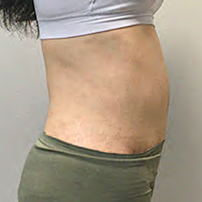 Liposuction Waist 09