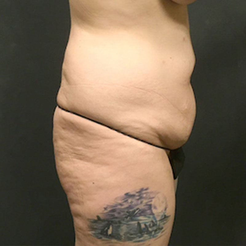 Liposuction Waist 03