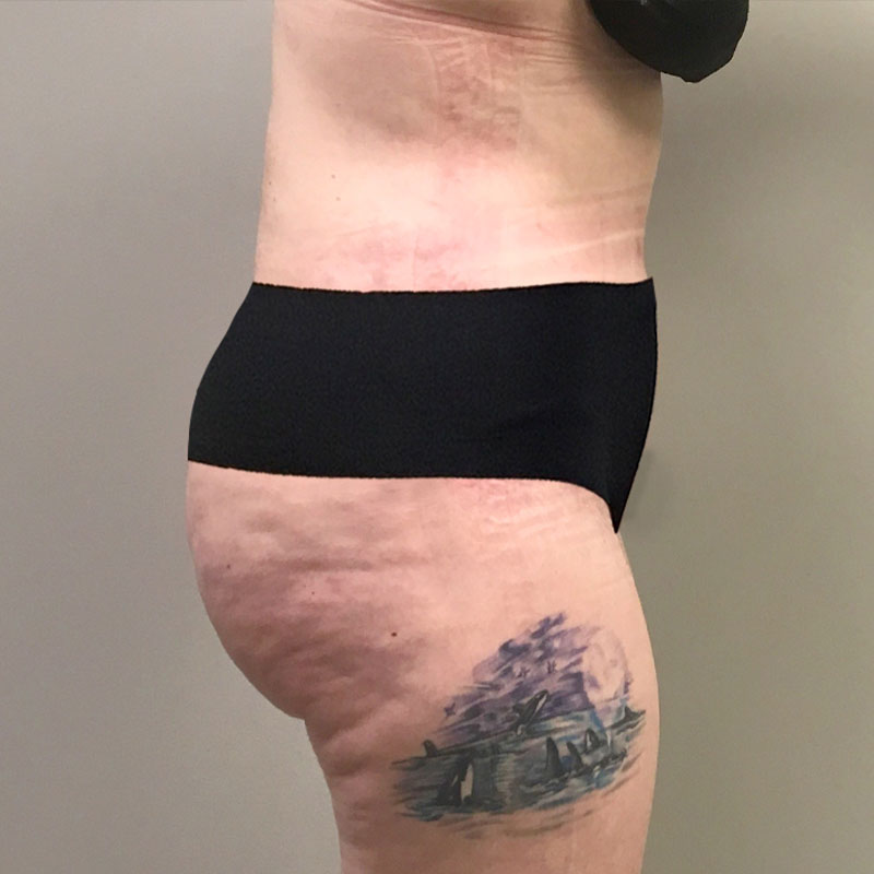 Liposuction Waist 03