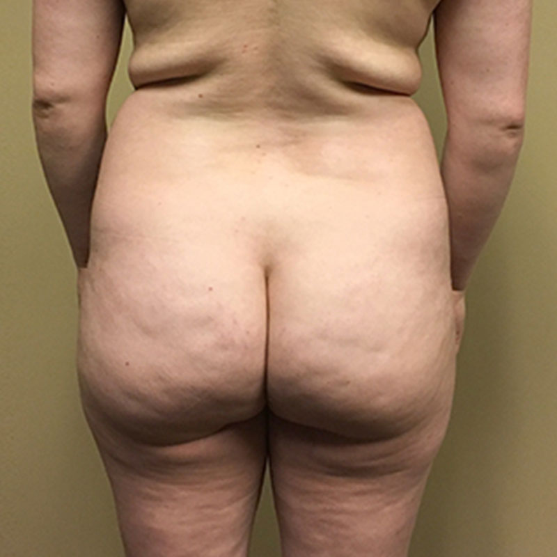 Liposuction Waist 01