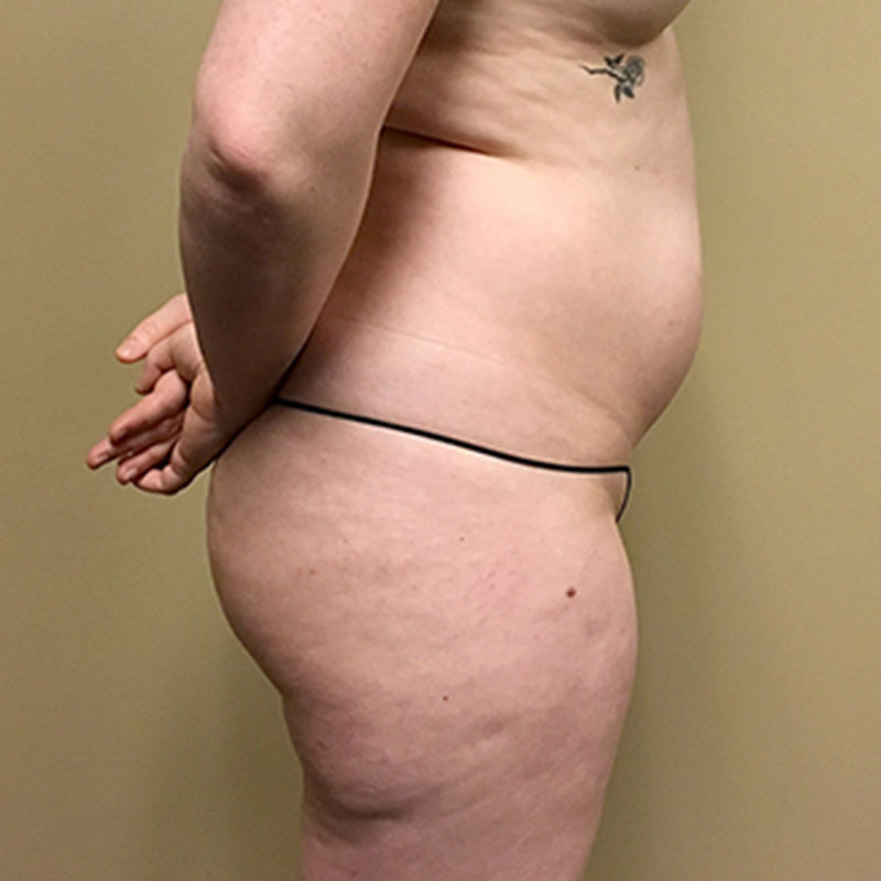 Liposuction Waist 05