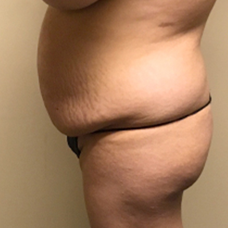 Liposuction Waist 05