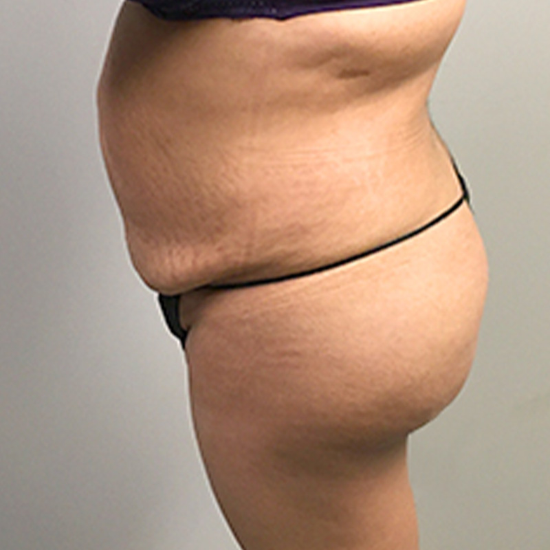 Liposuction Waist 05