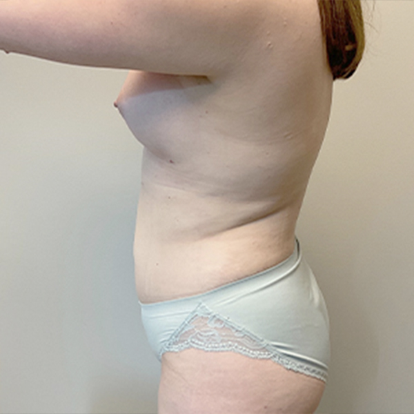 Liposuction Waist 05