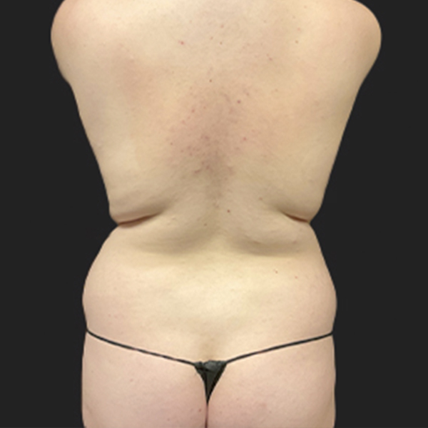 Liposuction Waist 11