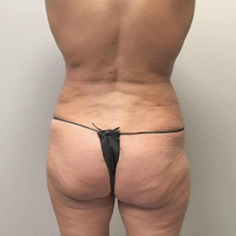 Liposuction Waist 30