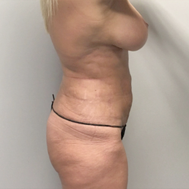 Liposuction Waist 13