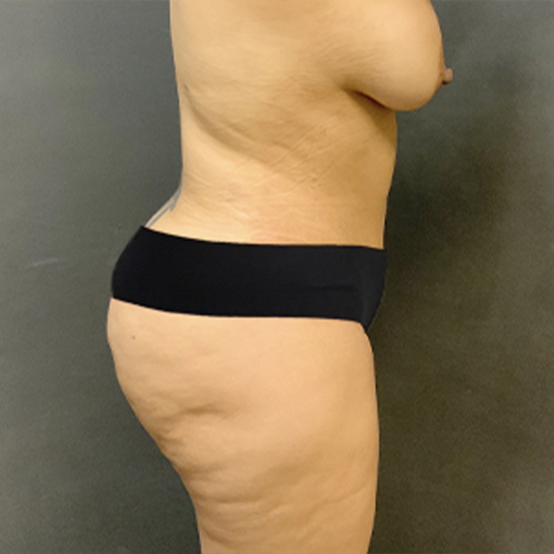 Liposuction Waist 05