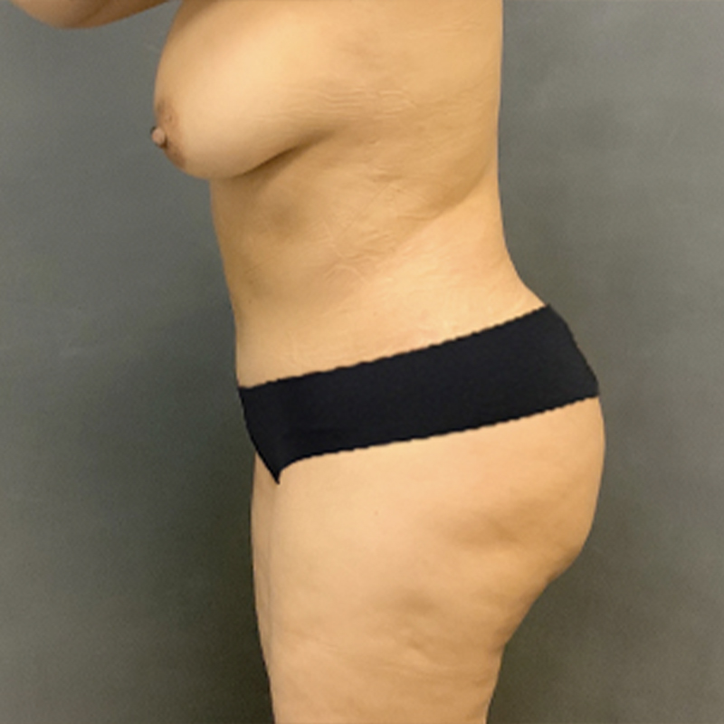 Liposuction Waist 09