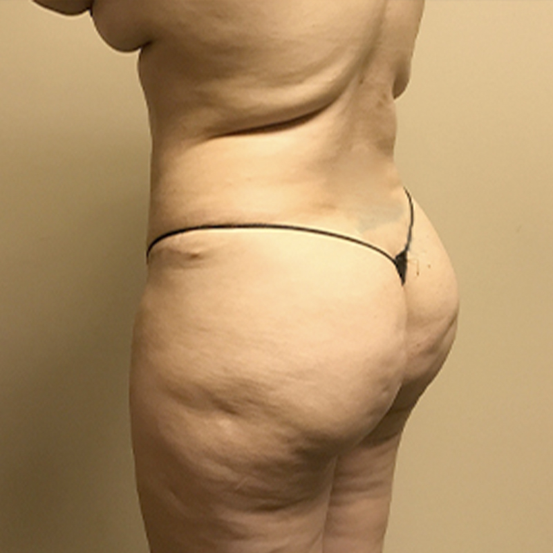 Liposuction Waist 11