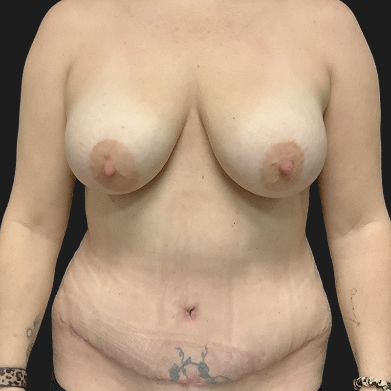 Liposuction Waist 32