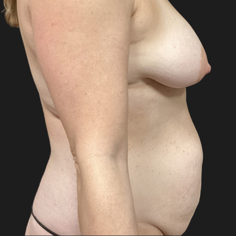 Liposuction Waist 05