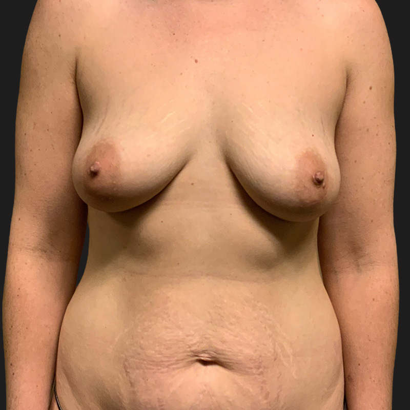 Liposuction Waist 01