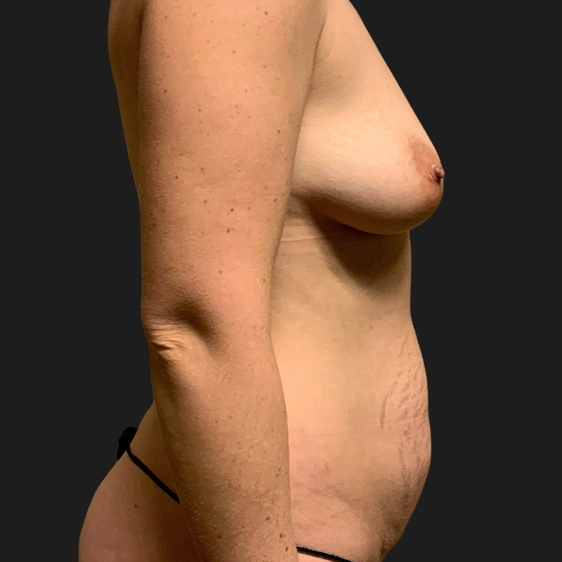 Liposuction Waist 05