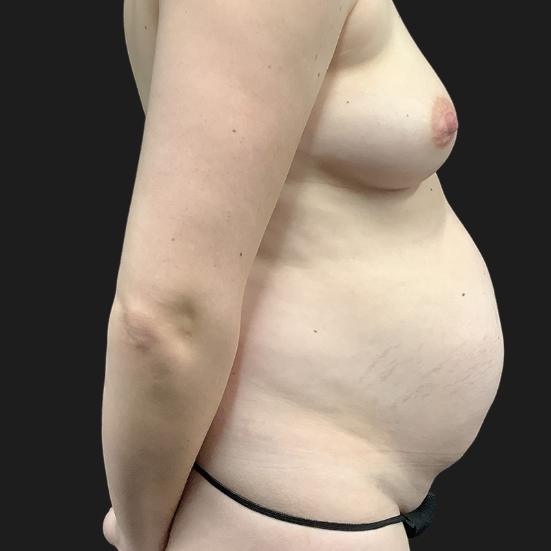 Liposuction Waist 01