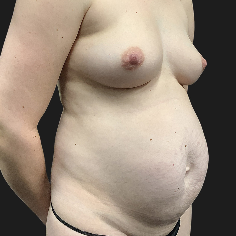 Liposuction Waist 03