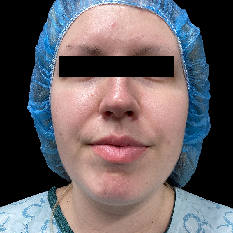 Lower Face Contouring 01