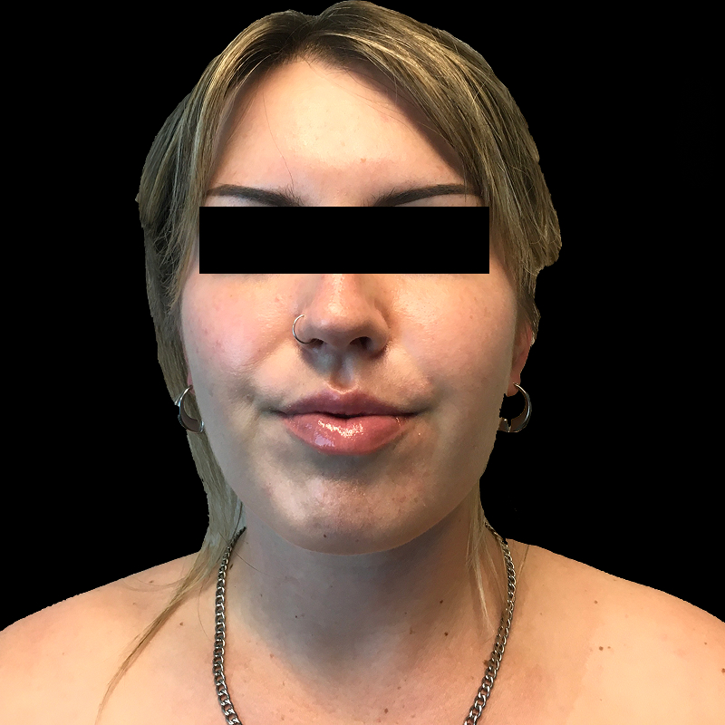 Lower Face Contouring 01