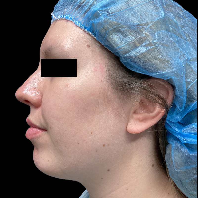 Lower Face Contouring 03