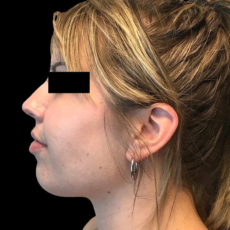 Lower Face Contouring 03