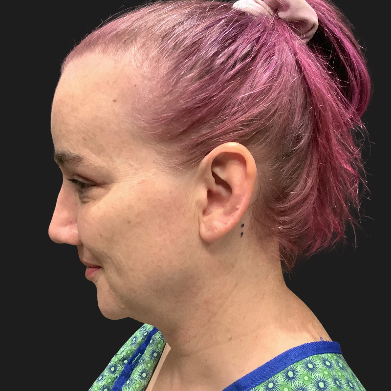 Lower Face Contouring 01