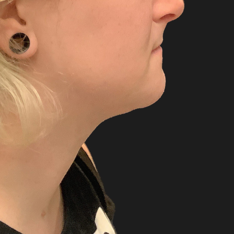 Lower Face Contouring 03