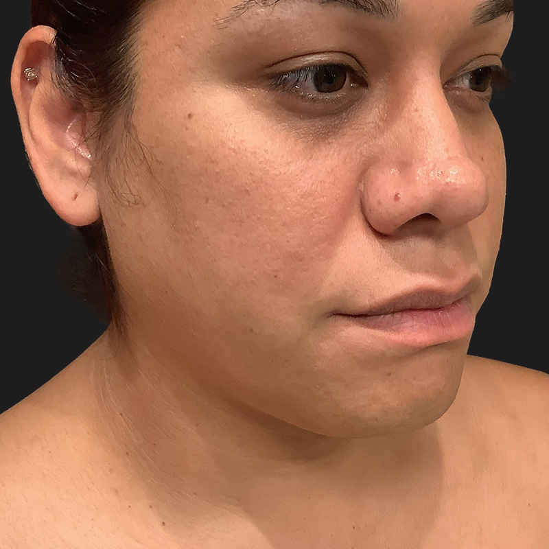 Lower Face Contouring 01