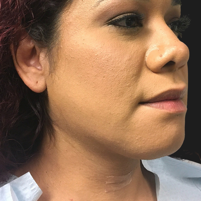 Lower Face Contouring 04