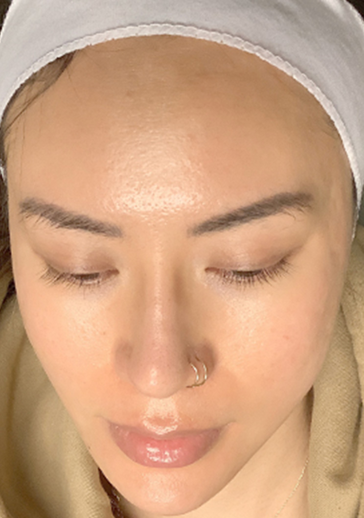 Microneedling 01