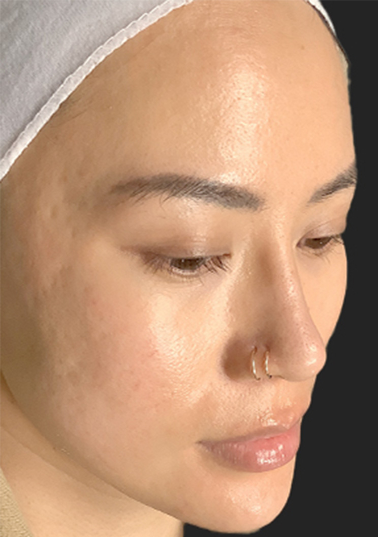 Microneedling 03