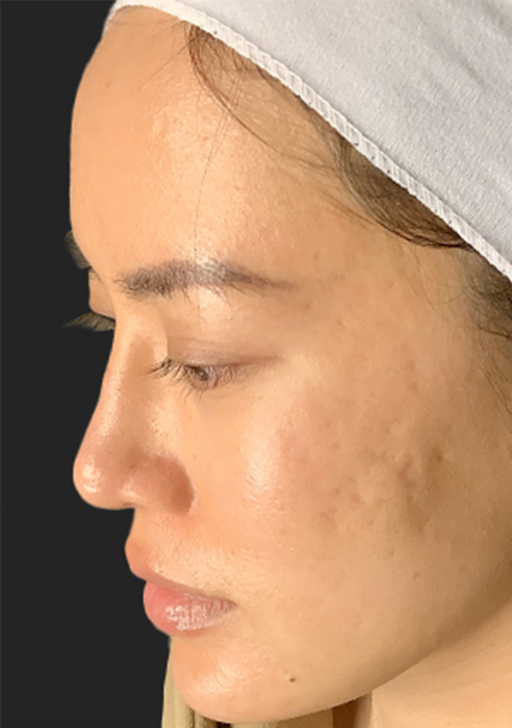 Microneedling 07