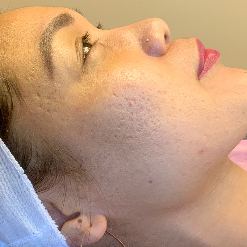 Microneedling 05
